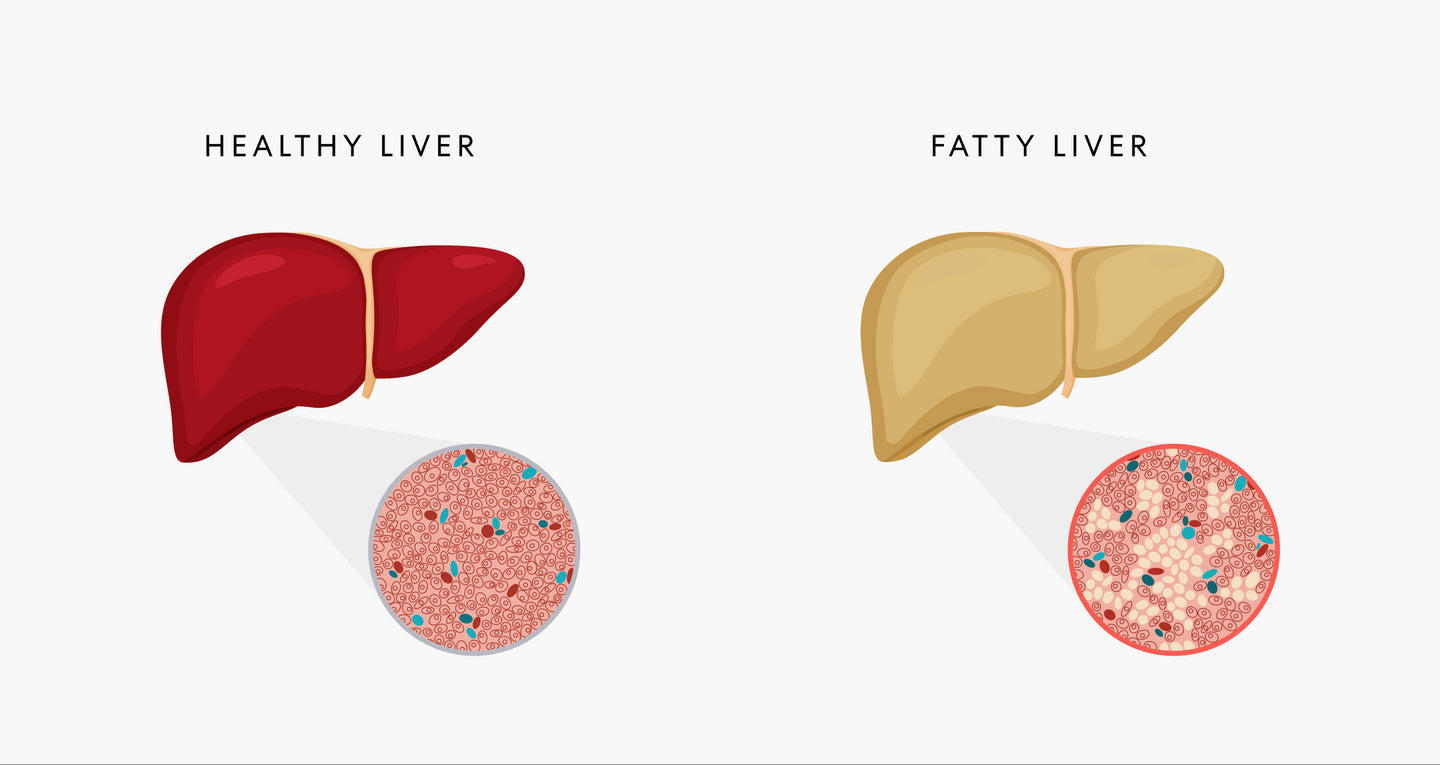 NAFLD - Fatty liver disease and diabetes - Reverse fatty liver disease - Insulin resistance and fatty liver disease - One Drop